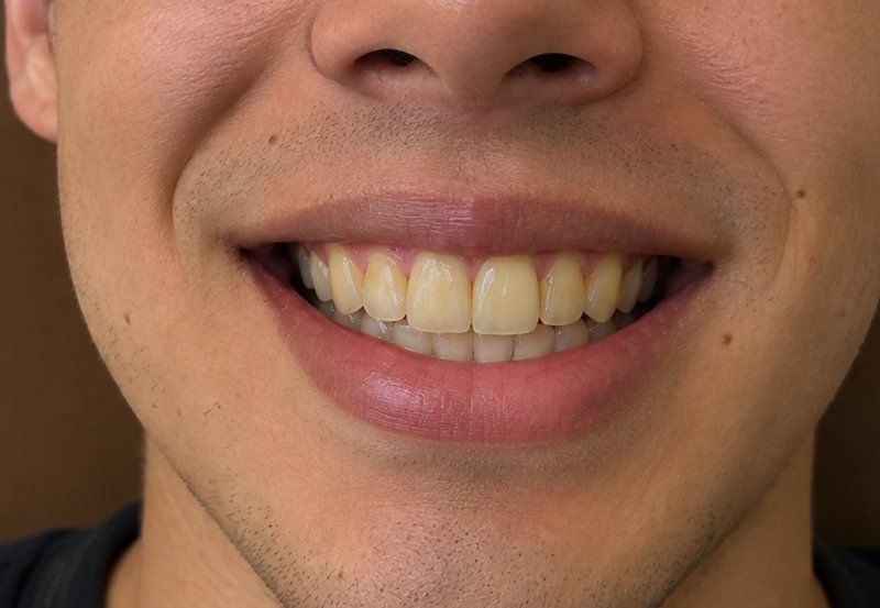 Illustrative simulation: smile before veneers