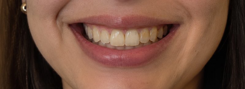 Illustrative simulation: smile before veneers