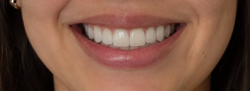 Illustrative simulation: smile after veneers